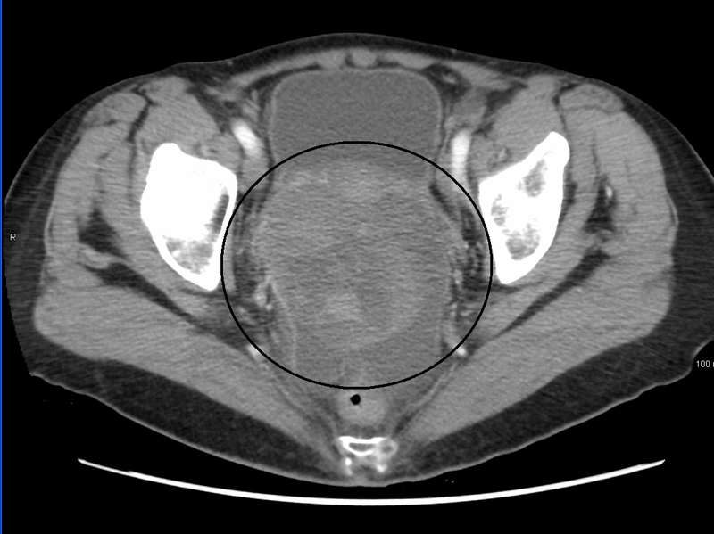 A very large ovarian cancer