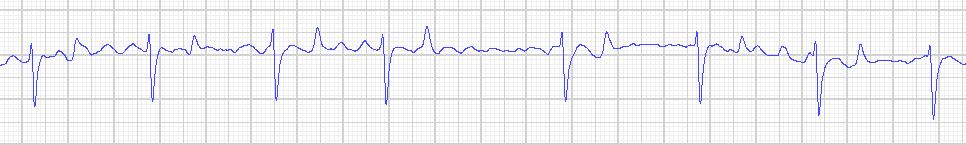 An EKG read out