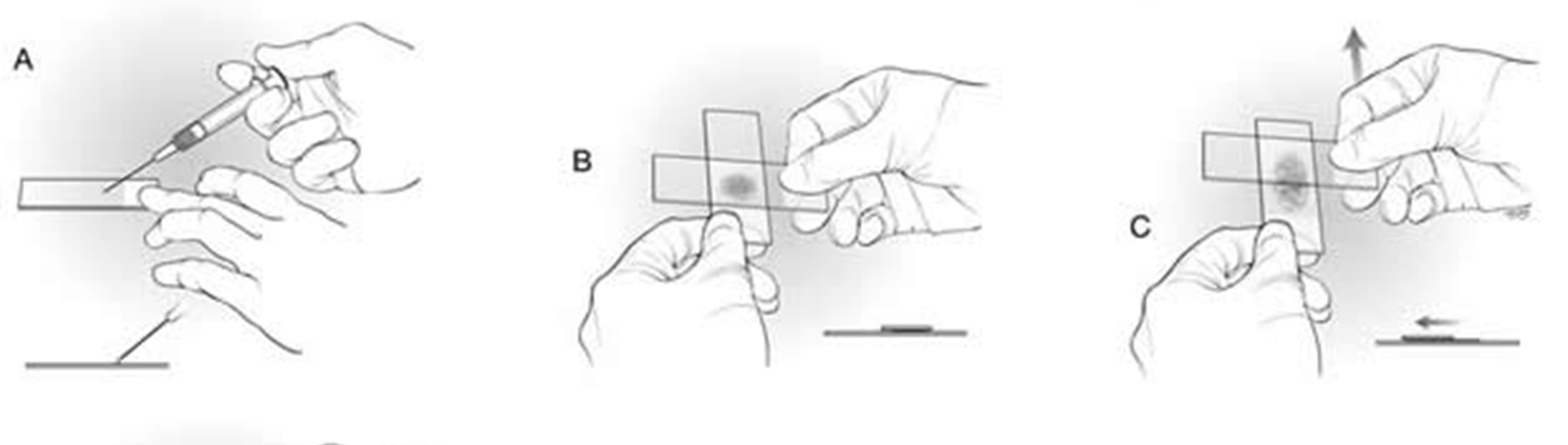 Squash technique for Cytology Slide Preparation