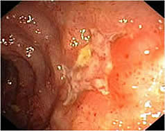 Colonoscopy image