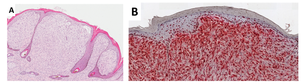 Equine sarcoid and related soft tissue sarcomas