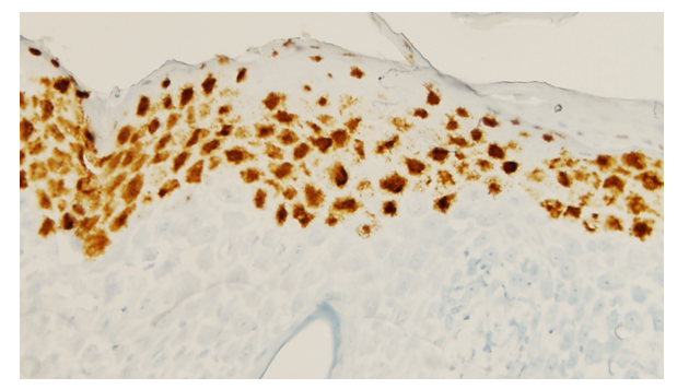 Lymphohistiocytic Interface Dermatitis in Horses