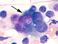 stained smear of a lymph node aspirate from a dog with a metastatic transitional cell carcinoma
