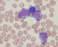 stained blood from a dog with acute megakaryoblastic leukemia