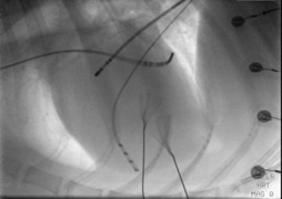Fluroscopic image of a heart with ablation catheters in place