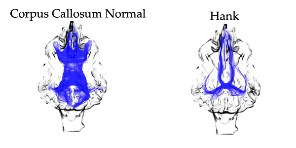 Comparison of a normal corpus callosum with Hank's malformation