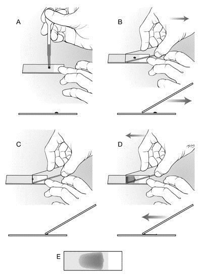 How to make a peripheral blood smear