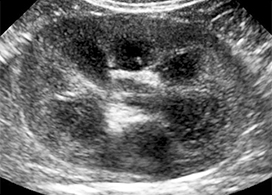 kidney ultrasound