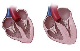 Thickening ventricular walls