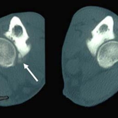 A computed tomographic slice through the elbow of a dog with fragmented medial coronoid process (part of the elbow dysplasia syndrome)