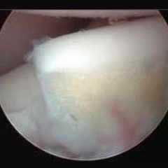 A computed tomographic slice through the elbow of a dog with fragmented medial coronoid process (part of the elbow dysplasia syndrome)