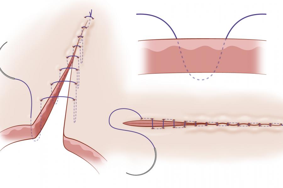 diagram on connell suture pattern