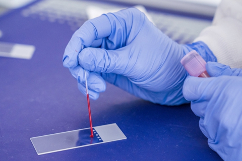 A gloved hand smears a blood sample on a microscope slide
