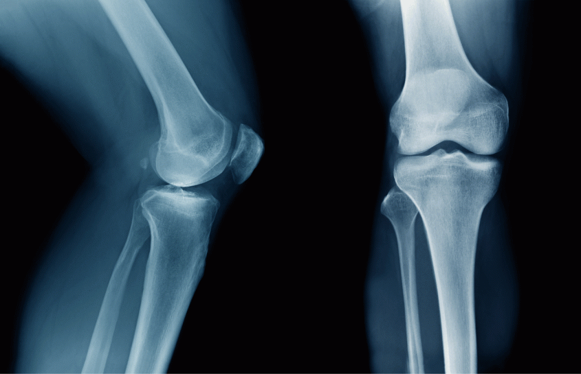 An X-ray of a knee