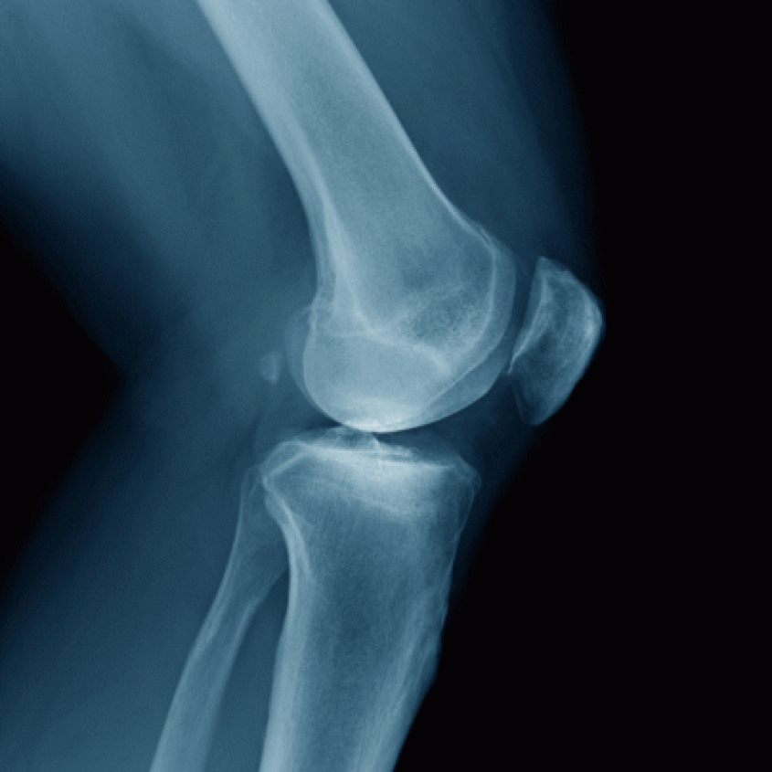 An X-ray of a knee