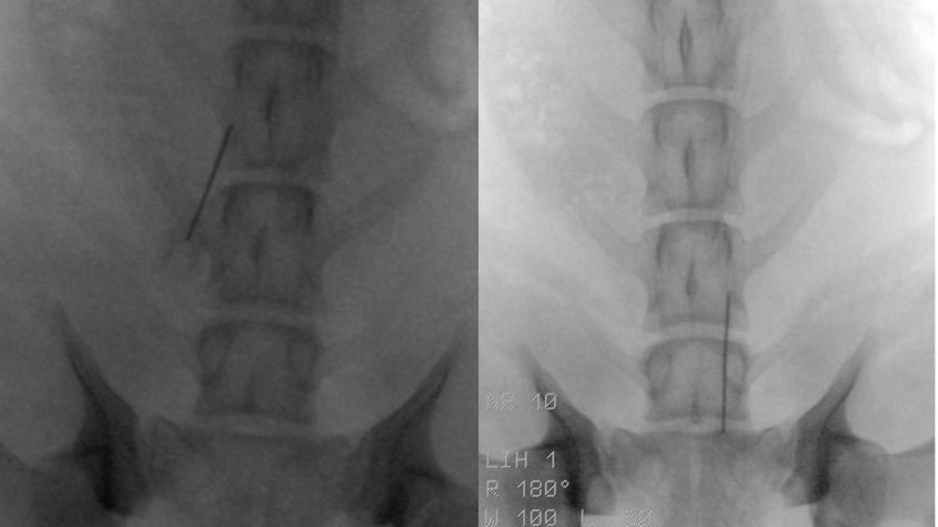 X-ray of Charley's lower spine