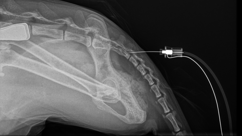 Miles' epidural placement x-ray