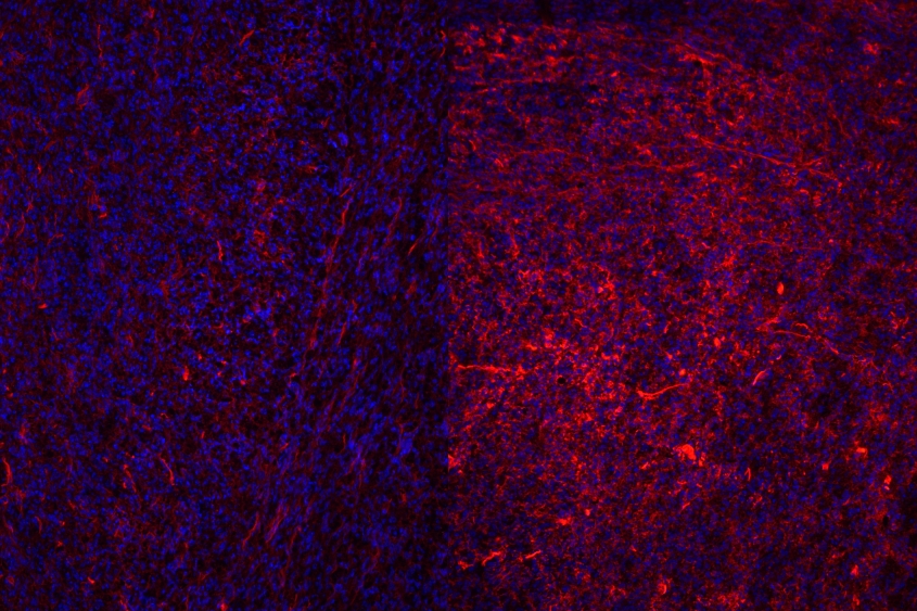 microscope image showing higher collagen density in resistant tumors compared to regressing ones