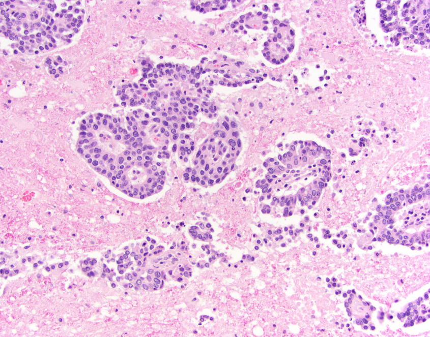 A microscope view of a disease 