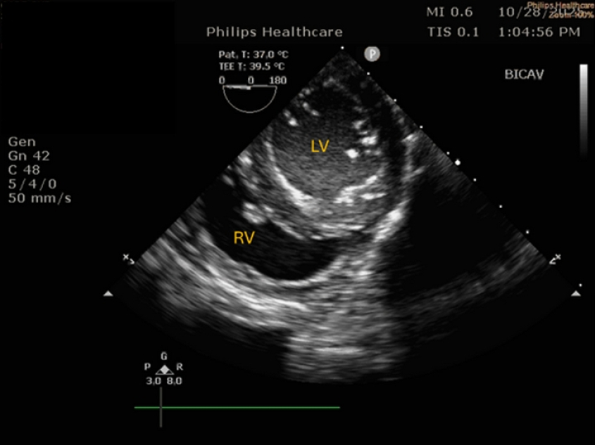Transesophageal echocardiography of Caudal-esophageal short axis