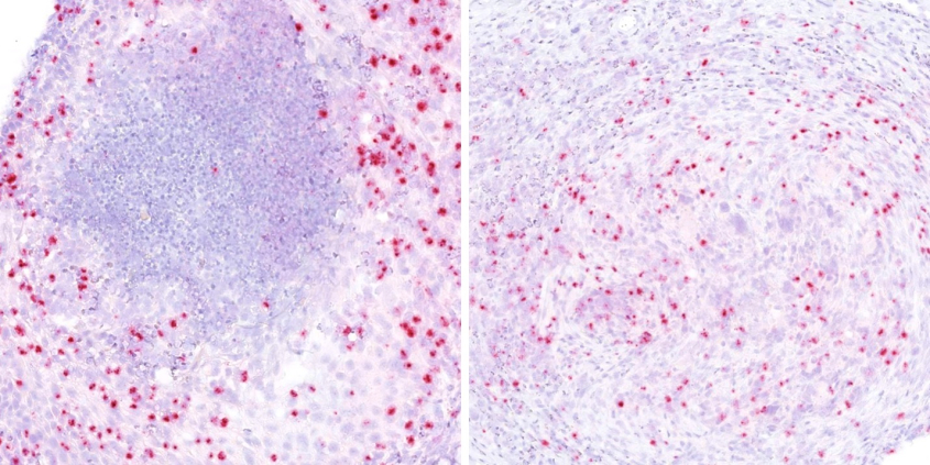 Photomicrograph of ISH with OvHV-2 probe of a cutaneous lesion in a goat