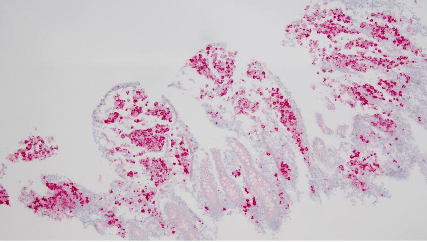 A section of small intestine with granulomatous enteritis