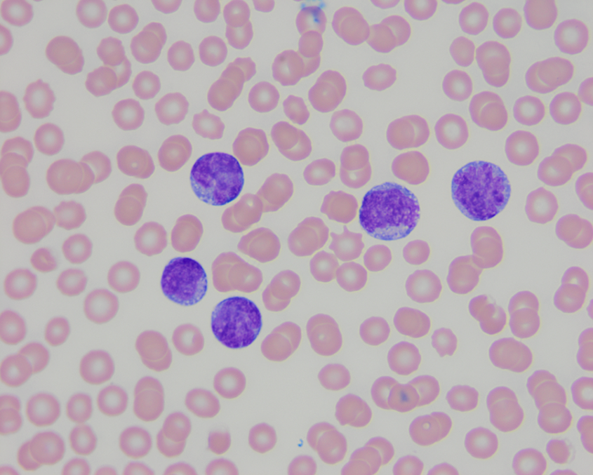 Blood cells showing AML tumor present