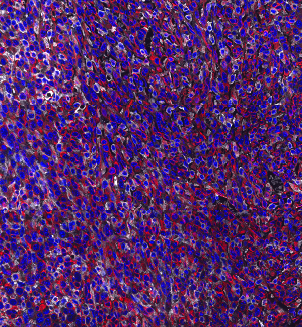 Murine breast tumor expressing E-cadherin (white), Vimentin (red) and DAPI (blue)