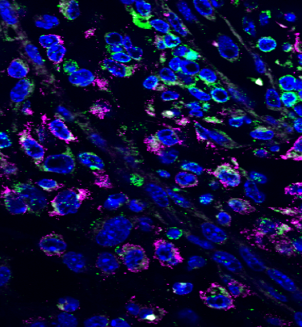 Immune cells present in a murine model of heterogeneous breast tumors. T-cells (purple), Macrophages (green) and DAPI (blue)