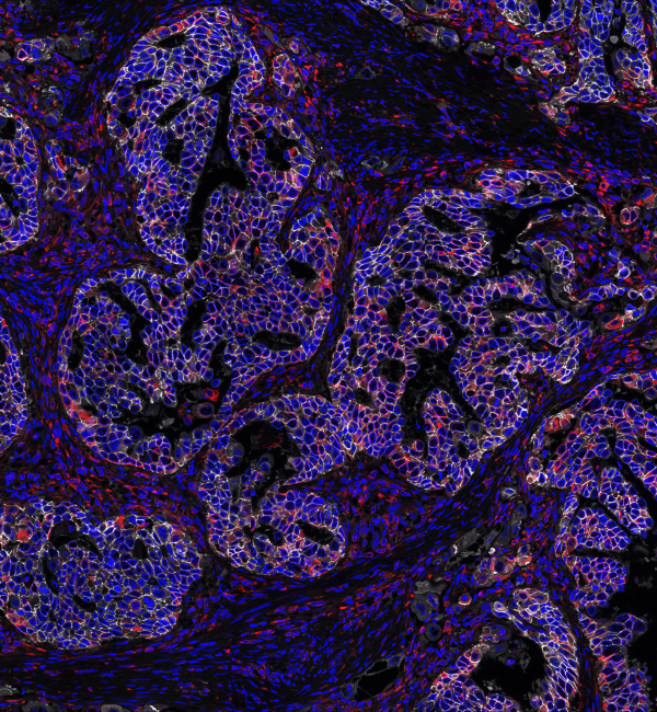 Feline mammary carcinoma expressing E-cadherin (white), Vimentin (red) and DAPI (blue)