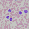 Blood cells showing AML tumor present