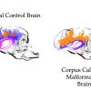 Side by side neuroimaging of a normal canine brain and a brain with copus callosum malformation