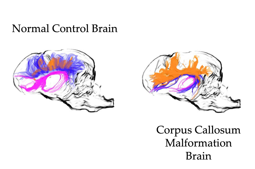 Side by side neuroimaging of a normal canine brain and a brain with copus callosum malformation